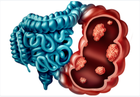 2020年第17届国际食管疾病大会（ISDE）延期更新