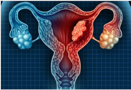 2020年第14届世界子宫内膜异位症大会每三年一届（WCE-WES）延期更新